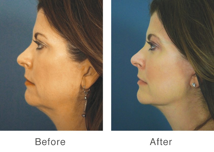 Los resultados transformadores son la marca de un cirujano excepcional. (Imágenes antes y después) Imágenes de antes y después de un mini lifting facial y injerto de grasa facial.